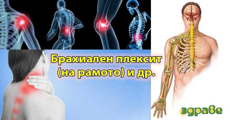 Упражнения и излекувани. Хапчета и пластири за брахиален плексит