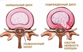 При дискова херния лечение с билки и мед